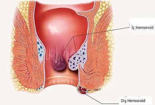 dış hemoroid